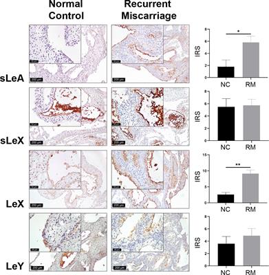 Targeting Aberrantly Elevated Sialyl Lewis A as a Potential Therapy for Impaired Endometrial Selection Ability in Unexplained Recurrent Miscarriage